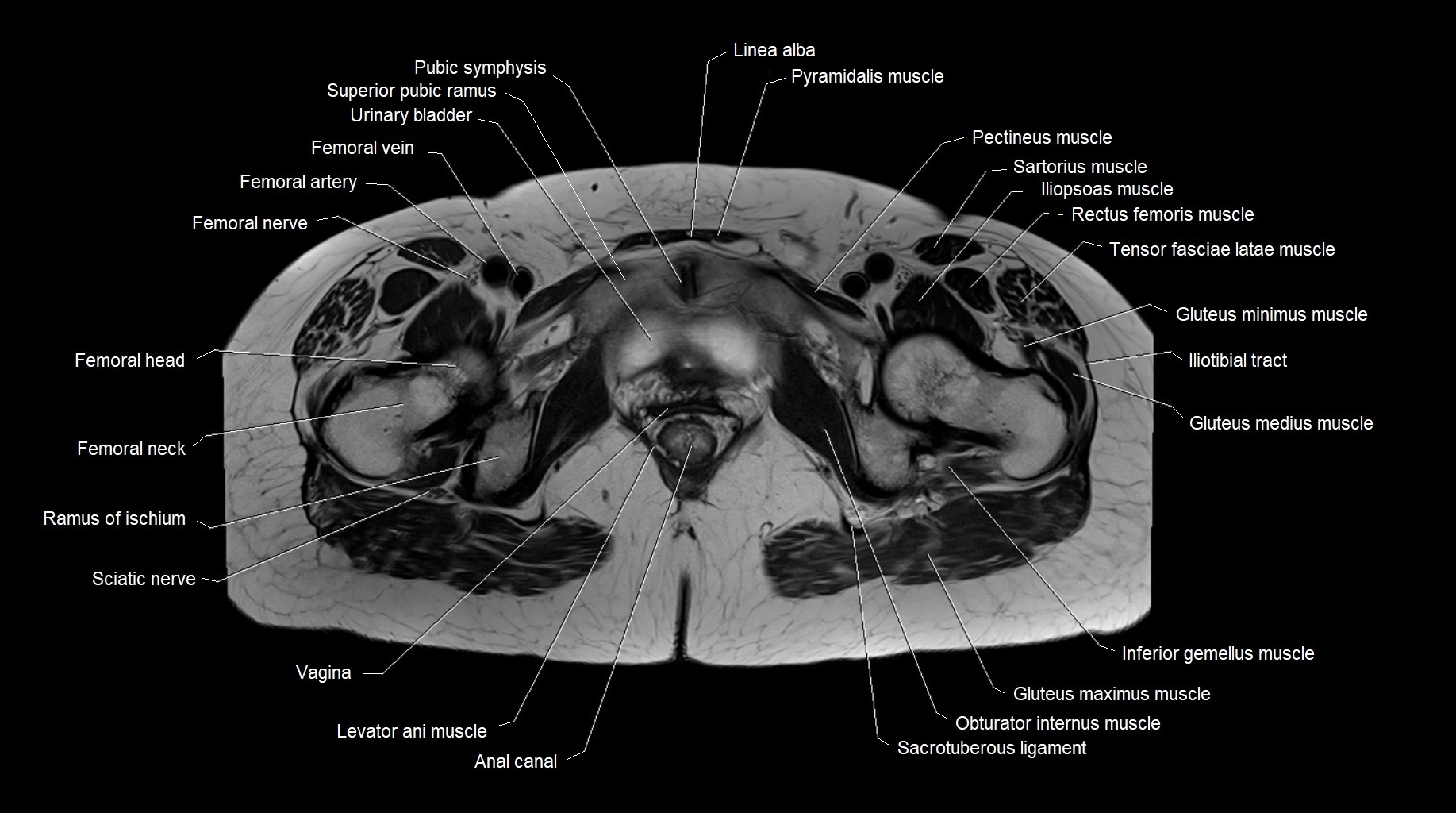 MRI 3T pelvis axial cross section anatomy image 26.webp